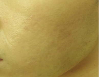 フラクショナル1ｂ