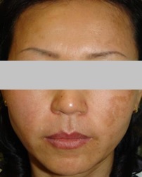 レーザートーニング1a