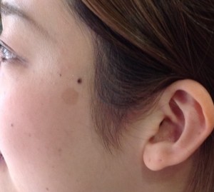 Ｂヤグレーザー症例20150619160227