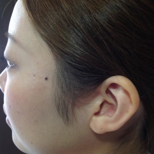 Ａヤグレーザー症例20150619160206