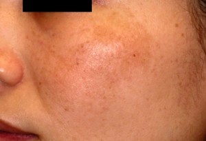 フラクショナルa