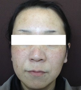 Bレーザートーニング