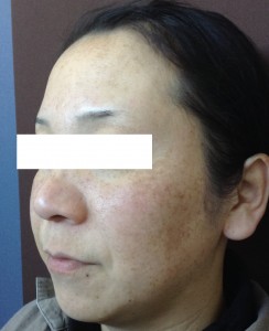 Bレーザートーニング横