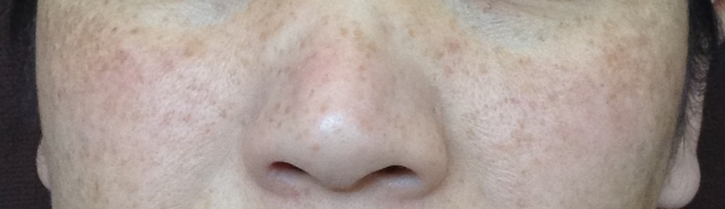 Bレーザートーニング部分