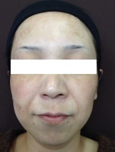 aレーザートーニング