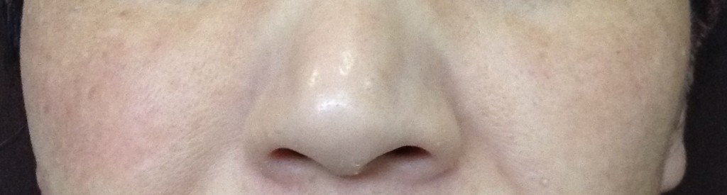 aレーザートーニング部分