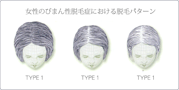 女性のびまん性脱毛症における脱毛パターン