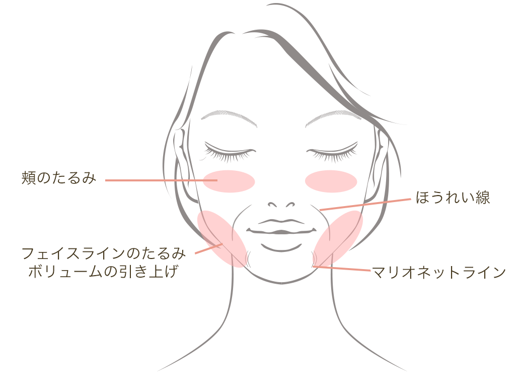 コグメッシュ3Dの効果的な部位