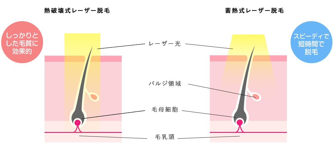 脱毛レーザーの比較