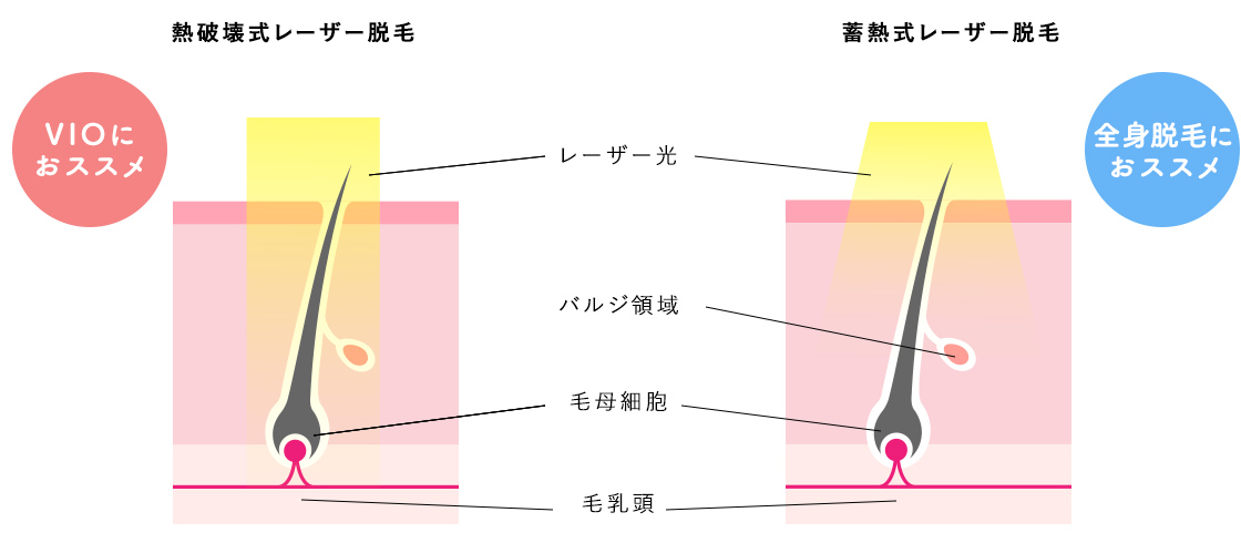 2種の脱毛機を解説