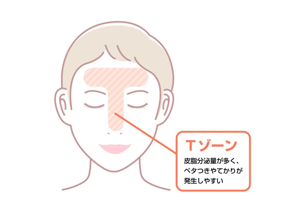 思春期ニキビができやすい場所とは?