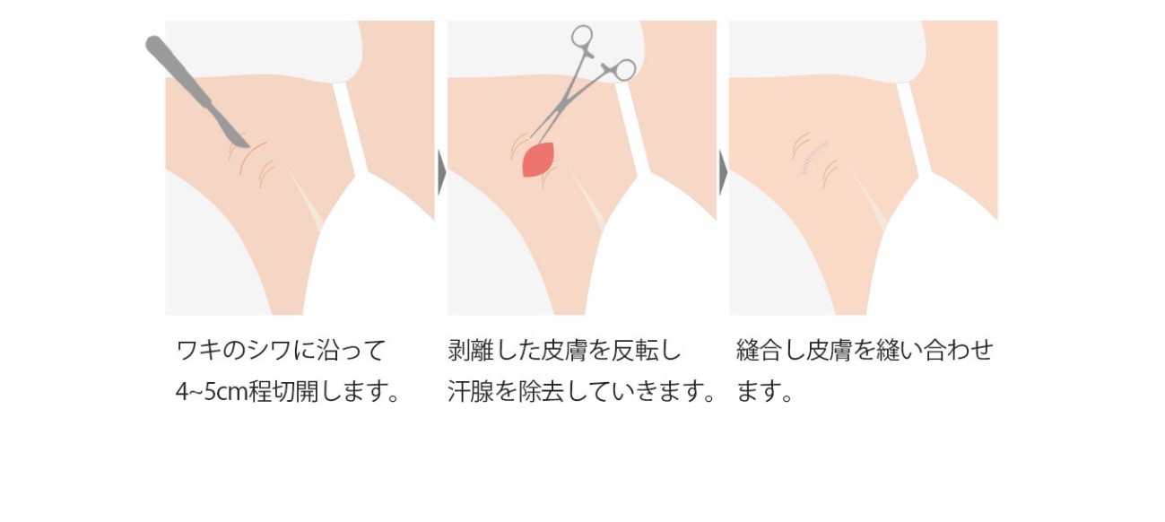 ワキガ治療（切開法）