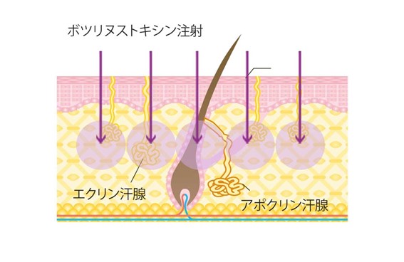 ボツリヌストキシンを注射