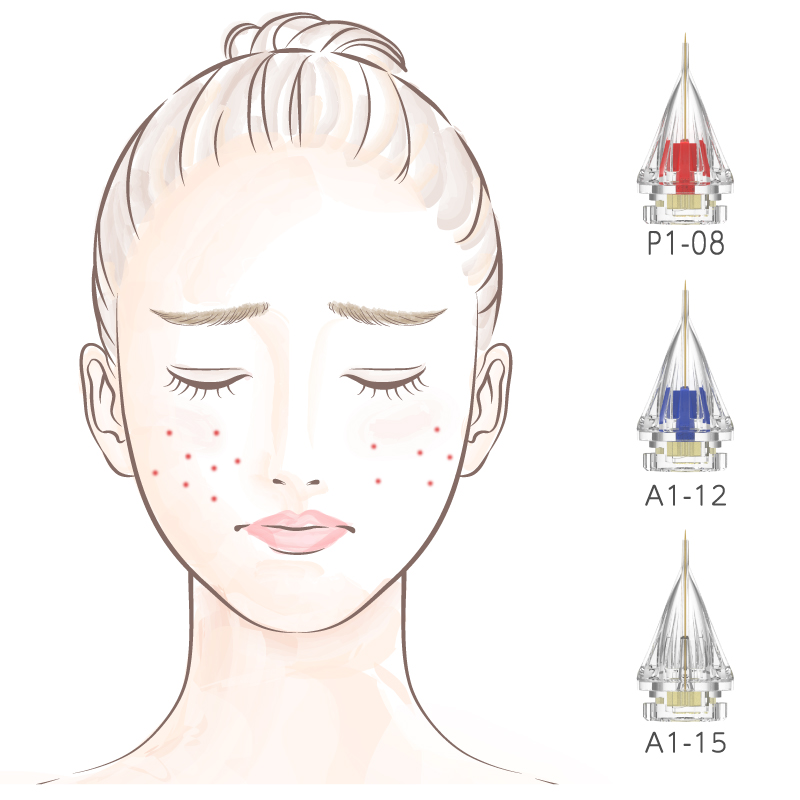 炎症性ニキビ治療