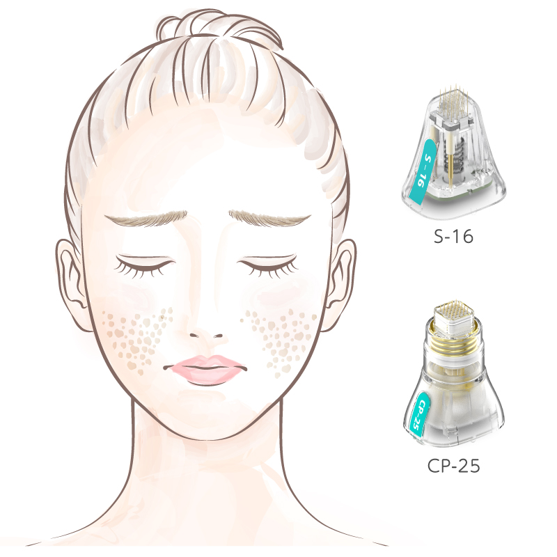 肌質改善・クレーター・ニキビ跡・毛穴