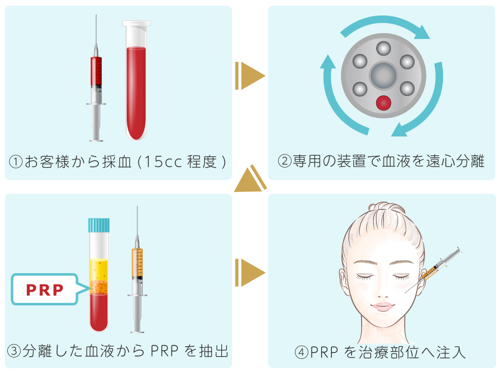 PRP皮膚再生療法の流れ