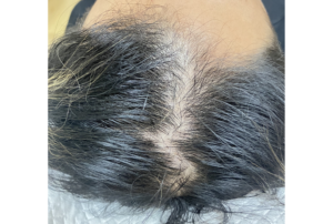 薄毛・AGA治療　ヘアフィラー・ヴェラルティス・フィナステリドの症例　治療前