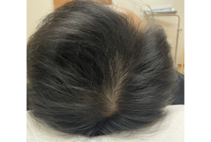 薄毛・AGA治療　ヘアフィラー・ヴェラルティス・フィナステリドの症例　治療後