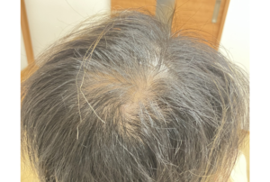 薄毛・AGA治療　ヘアフィラー・ヴェラルティス・フィナステリドの症例　治療前