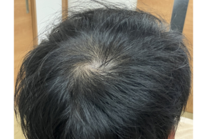 薄毛・AGA治療　ヘアフィラー・ヴェラルティス・フィナステリドの症例　治療後