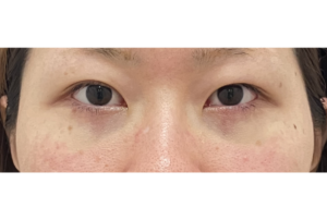経結膜脱脂法　術後