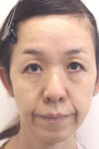 肌の再生医療の症例　術前