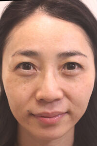 肌の再生医療の症例　術前