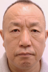 肌の再生医療症例　術前