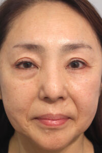 肌の再生医療の症例　術前