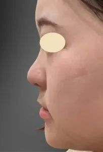 テスリフトノーズの症例　術前