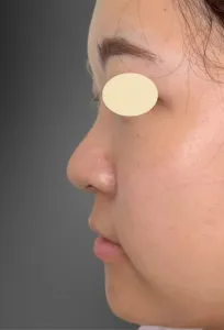 テスリフトノーズの症例　3か月後