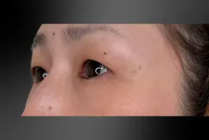 経結膜脱脂法+上眼瞼脱脂+二重埋没法3点留めの症例　術前