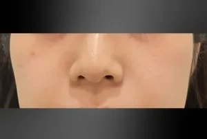 ほくろ除去レーザーの症例　術後