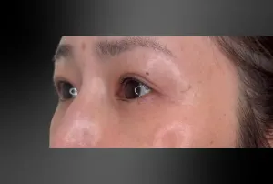 経結膜脱脂法+上眼瞼脱脂+二重埋没法3点留めの症例　3か月後