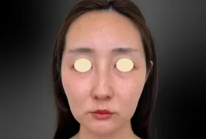 脂肪吸引（フェイスライン）の症例　術前