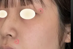ほくろ除去レーザーの症例　術前