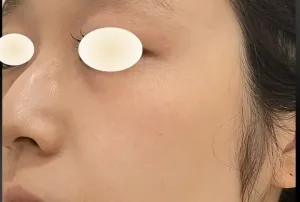 ほくろ除去レーザーの症例　術後