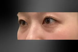 経結膜脱脂法の症例　術前