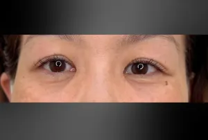 経結膜脱脂法の症例　1ヶ月後
