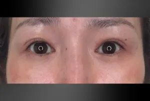 経結膜脱脂法+上眼瞼脱脂+二重埋没法3点留めの症例　3か月後