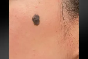 ほくろ切開の症例　術前