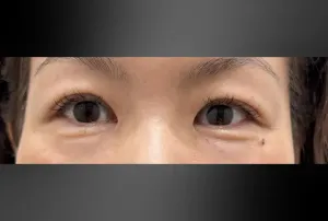 経結膜脱脂法の症例　術前