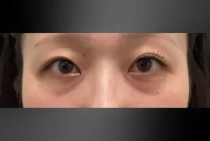 経結膜脱脂法の症例　術前