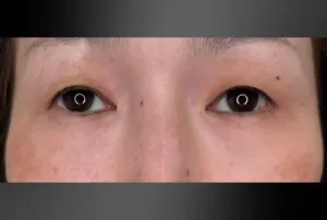 経結膜脱脂法+上眼瞼脱脂+二重埋没法3点留めの症例　術前