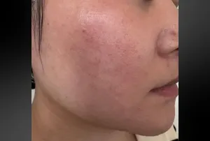 スキンケア外来の症例　Before